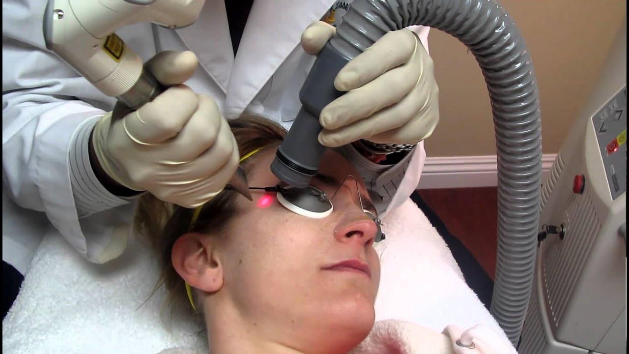Smartxide Dot Lazer