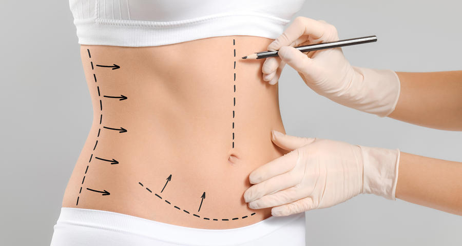 Vaser Destekli Liposuction