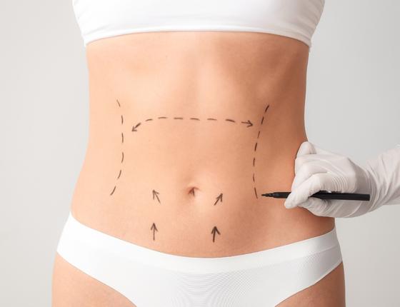 Abdominoplasti Öncesi Yapmanız Gerekenler