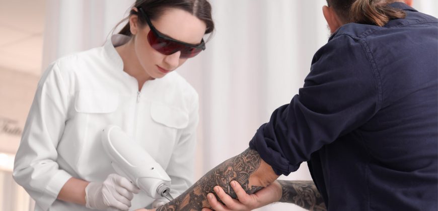 Lazerle Dövme Silme Sıkça Sorulan Sorular