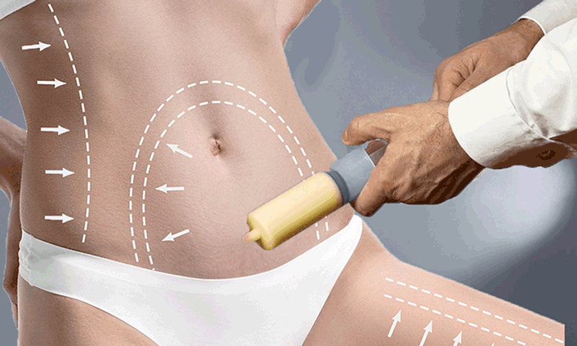 Liposuction ile Yağ Aldırma Ameliyatı